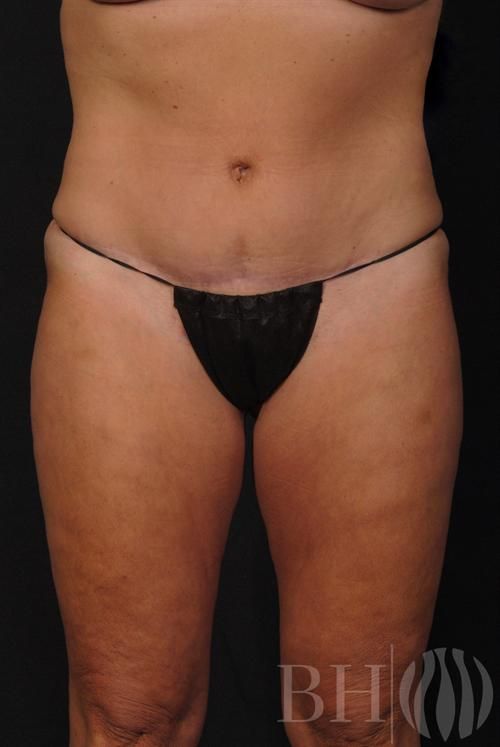 Tummy Tuck Before & After