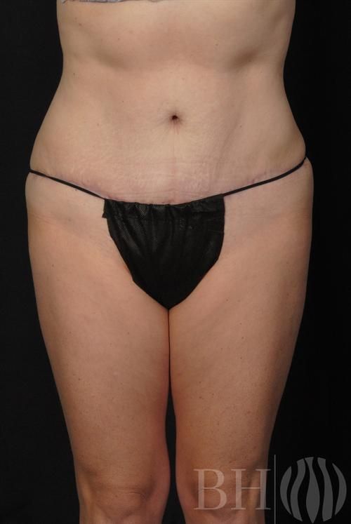 Tummy Tuck Before & After