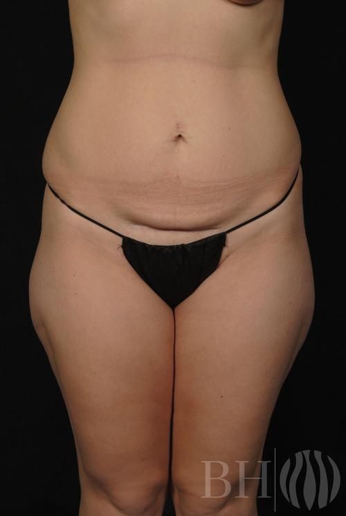 Tummy Tuck Before & After