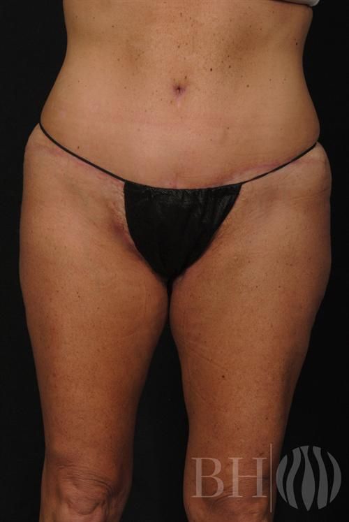 Tummy Tuck Before & After