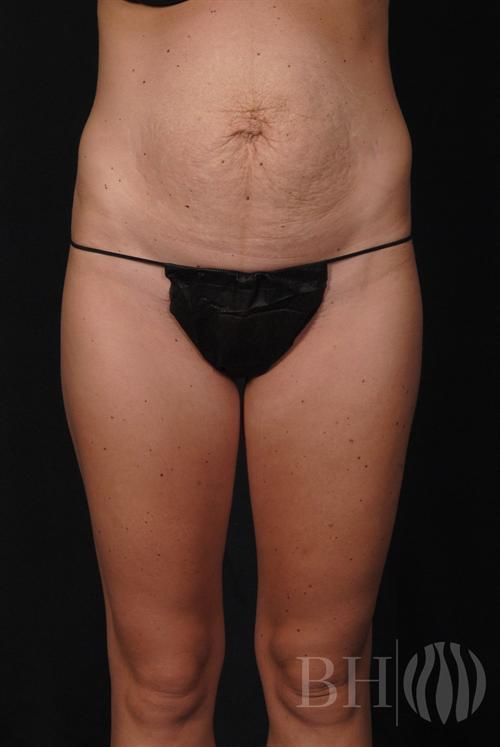 Tummy Tuck Before & After