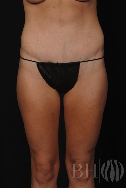 Tummy Tuck Before & After