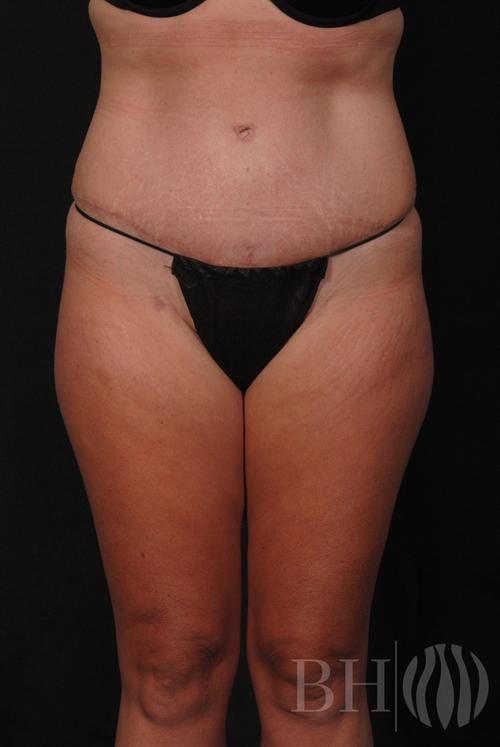 Tummy Tuck Before & After