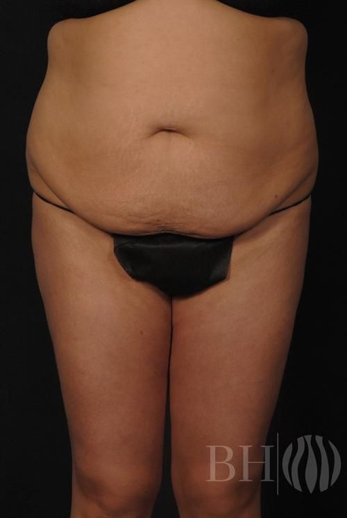 Tummy Tuck Before & After