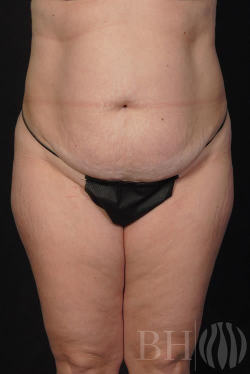 Tummy Tuck Before & After