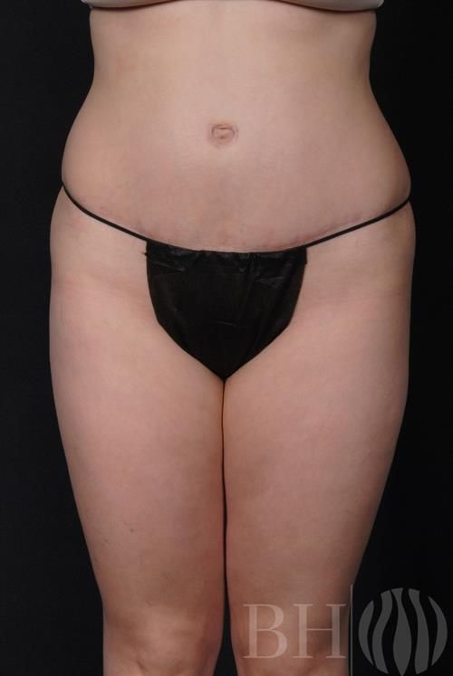Tummy Tuck Before & After