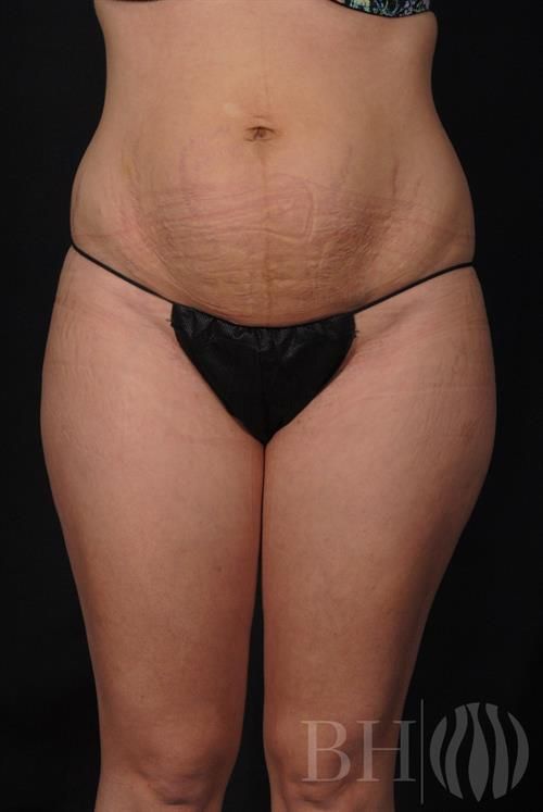Tummy Tuck Before & After