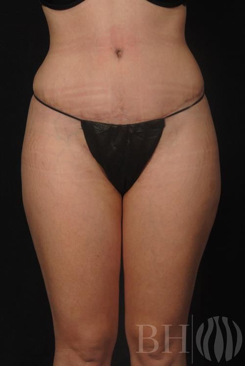 Tummy Tuck Before & After