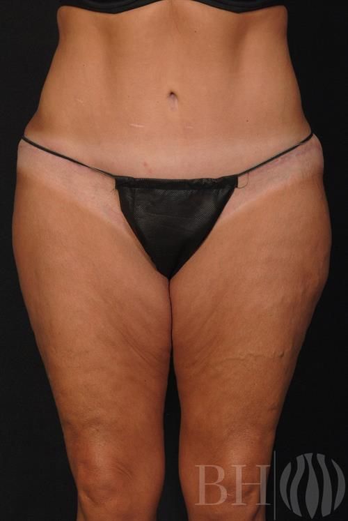 Tummy Tuck Before & After