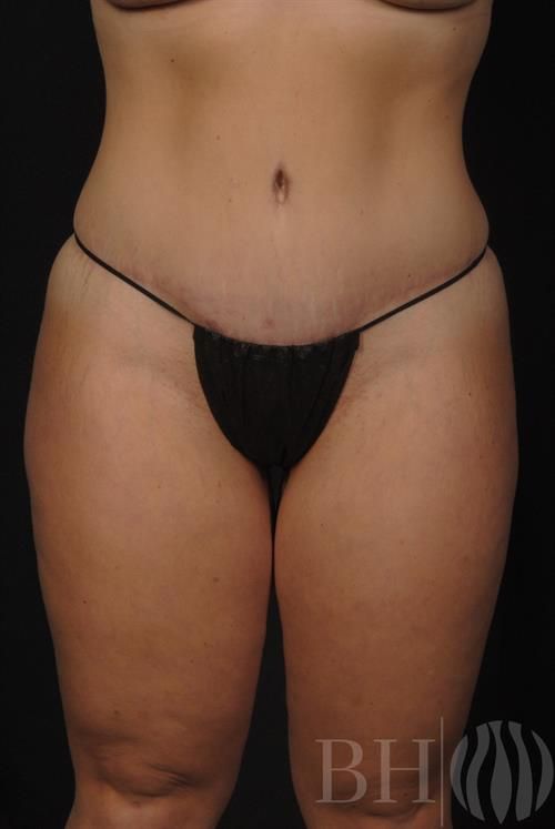 Tummy Tuck Before & After