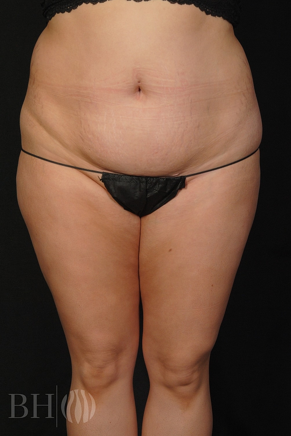 Tummy Tuck Before & After