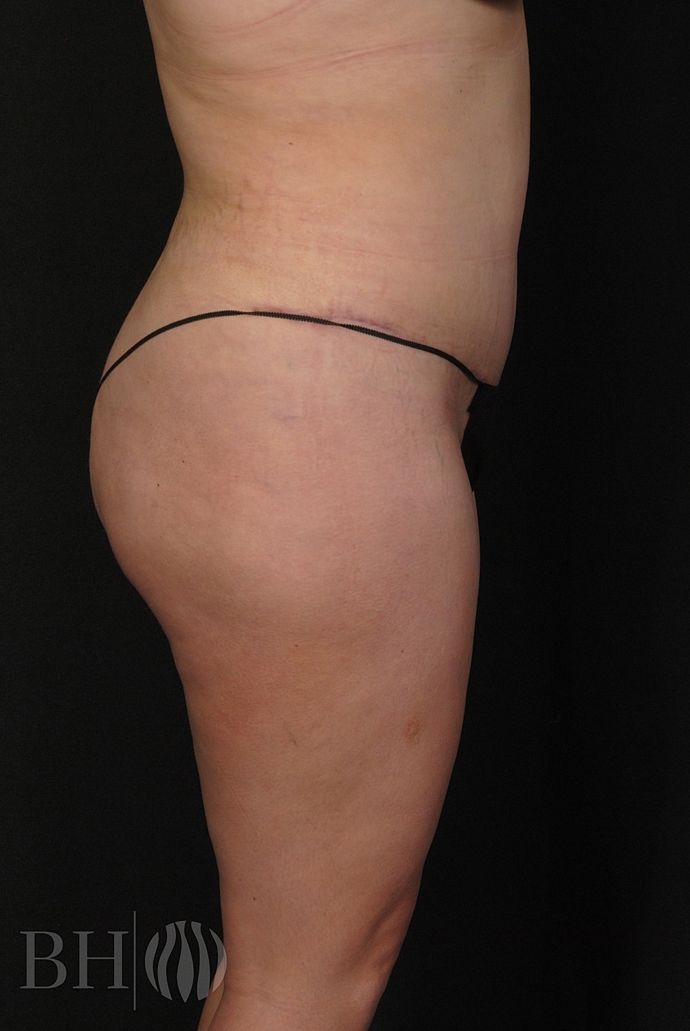 Tummy Tuck Before & After