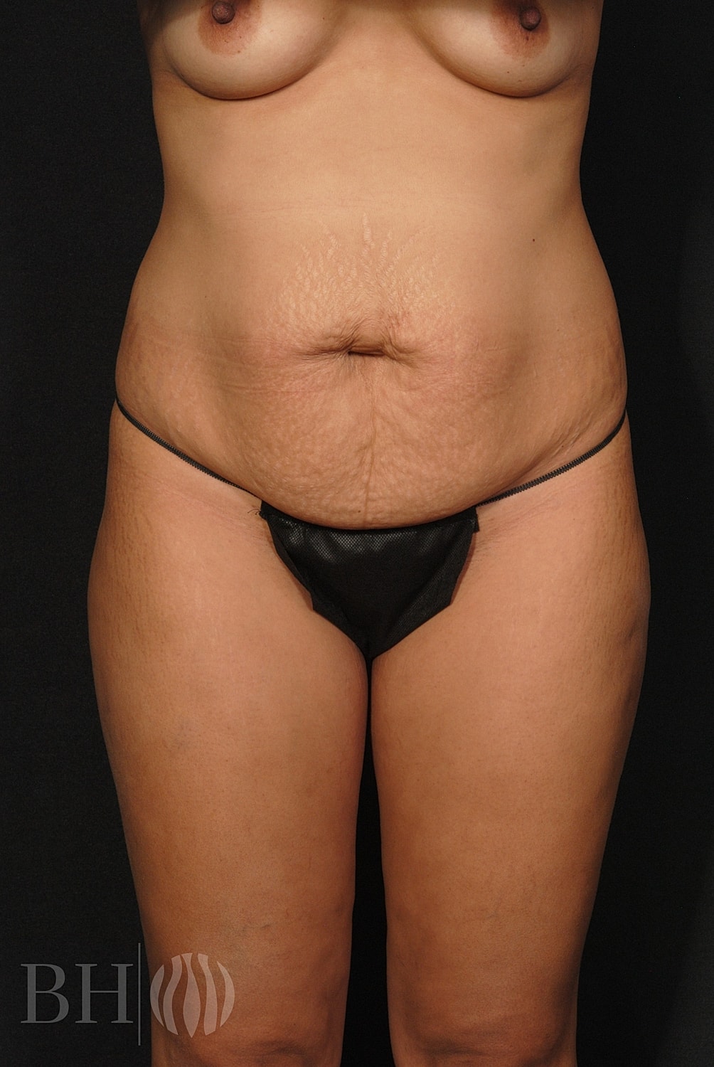 Tummy Tuck Before & After