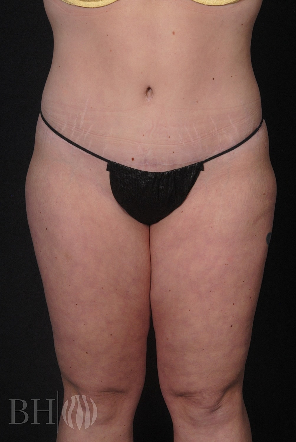 Tummy Tuck Before & After