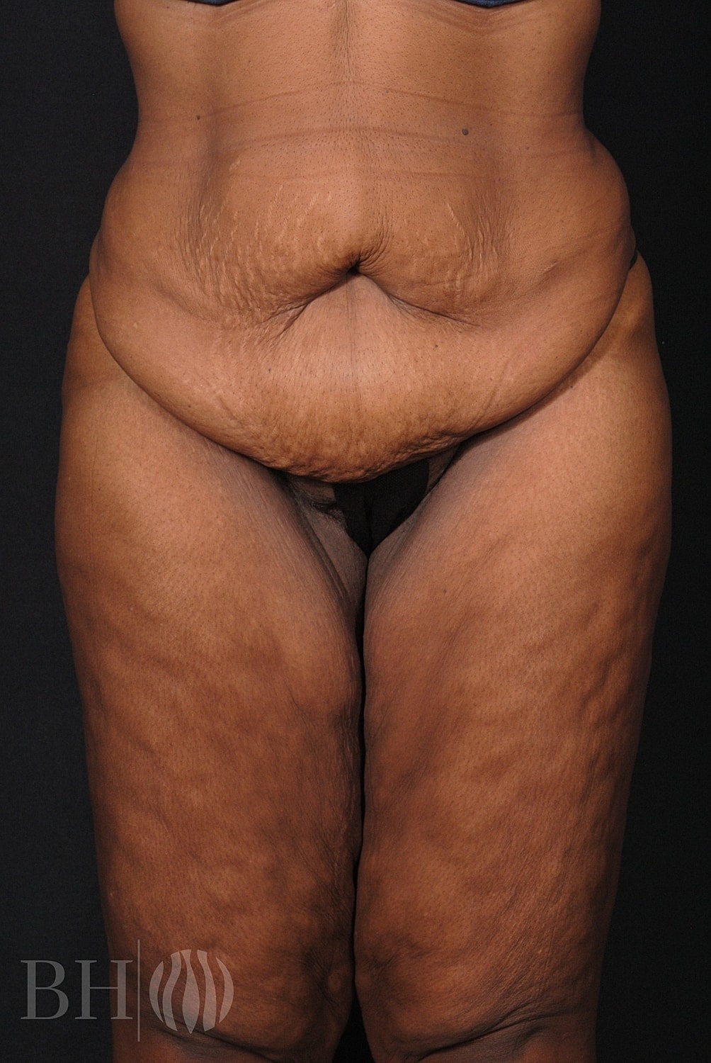 Tummy Tuck Before & After