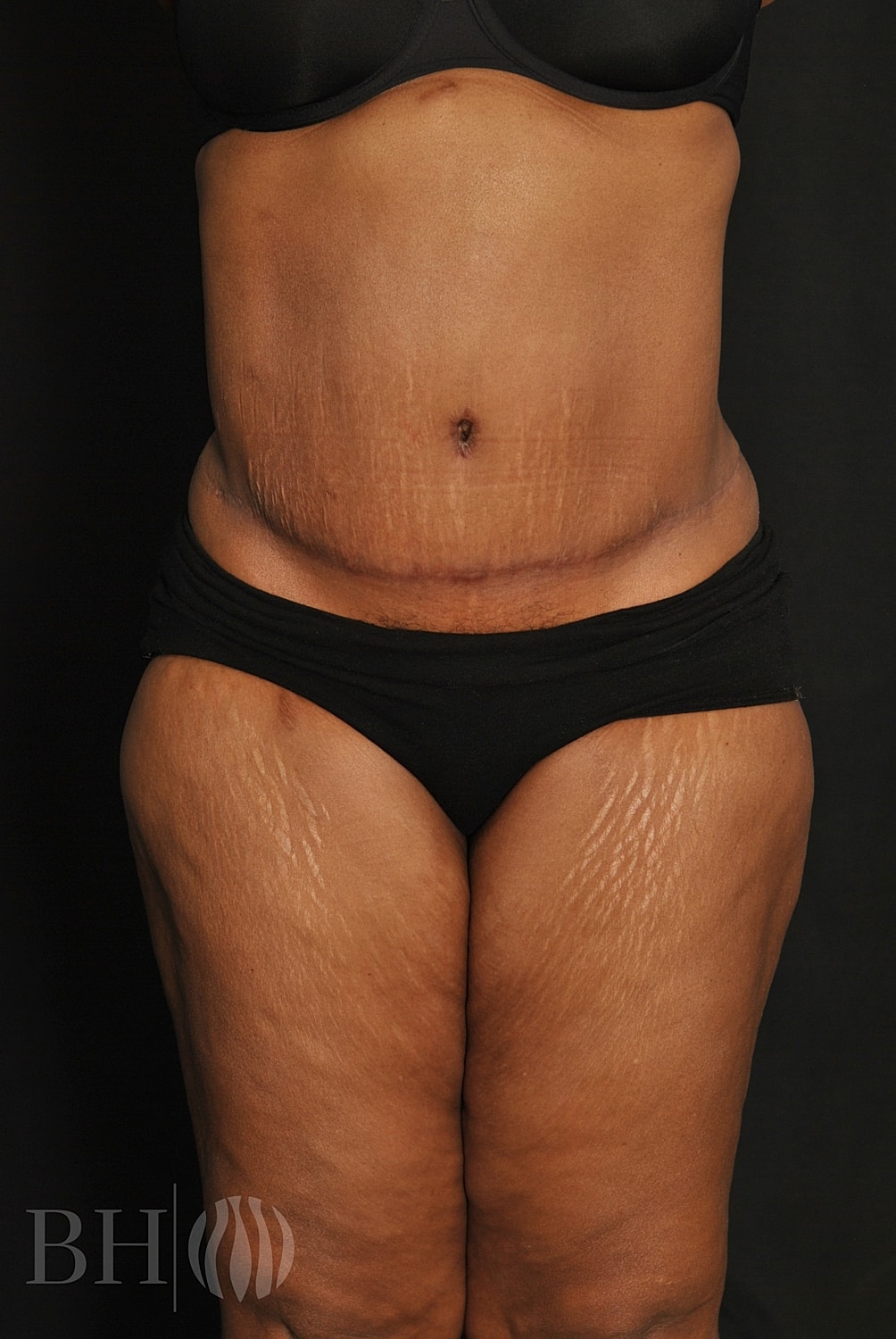 Tummy Tuck Before & After
