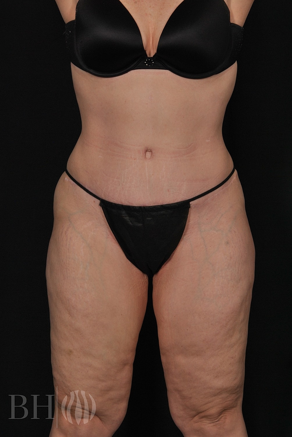 Tummy Tuck Before & After
