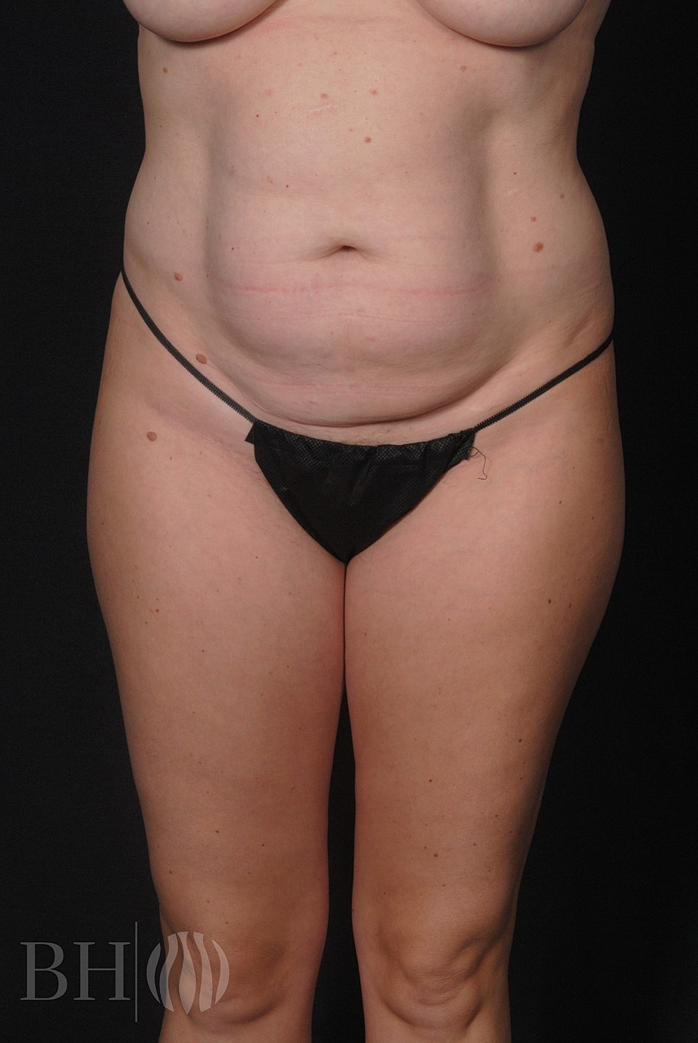 Tummy Tuck Before & After