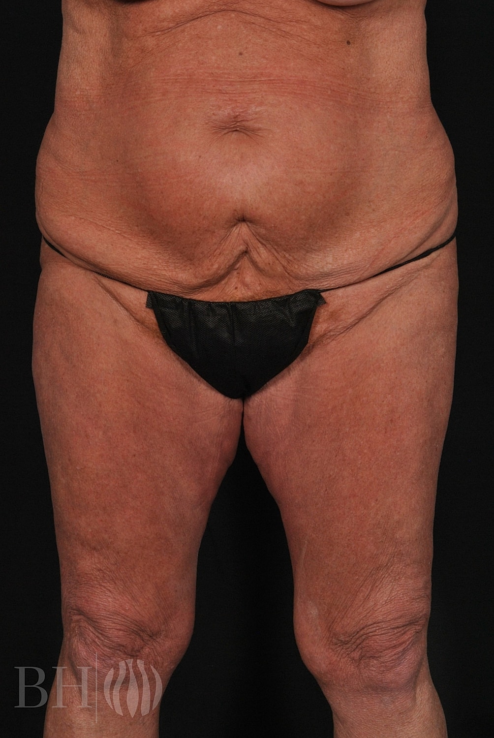 Tummy Tuck Before & After