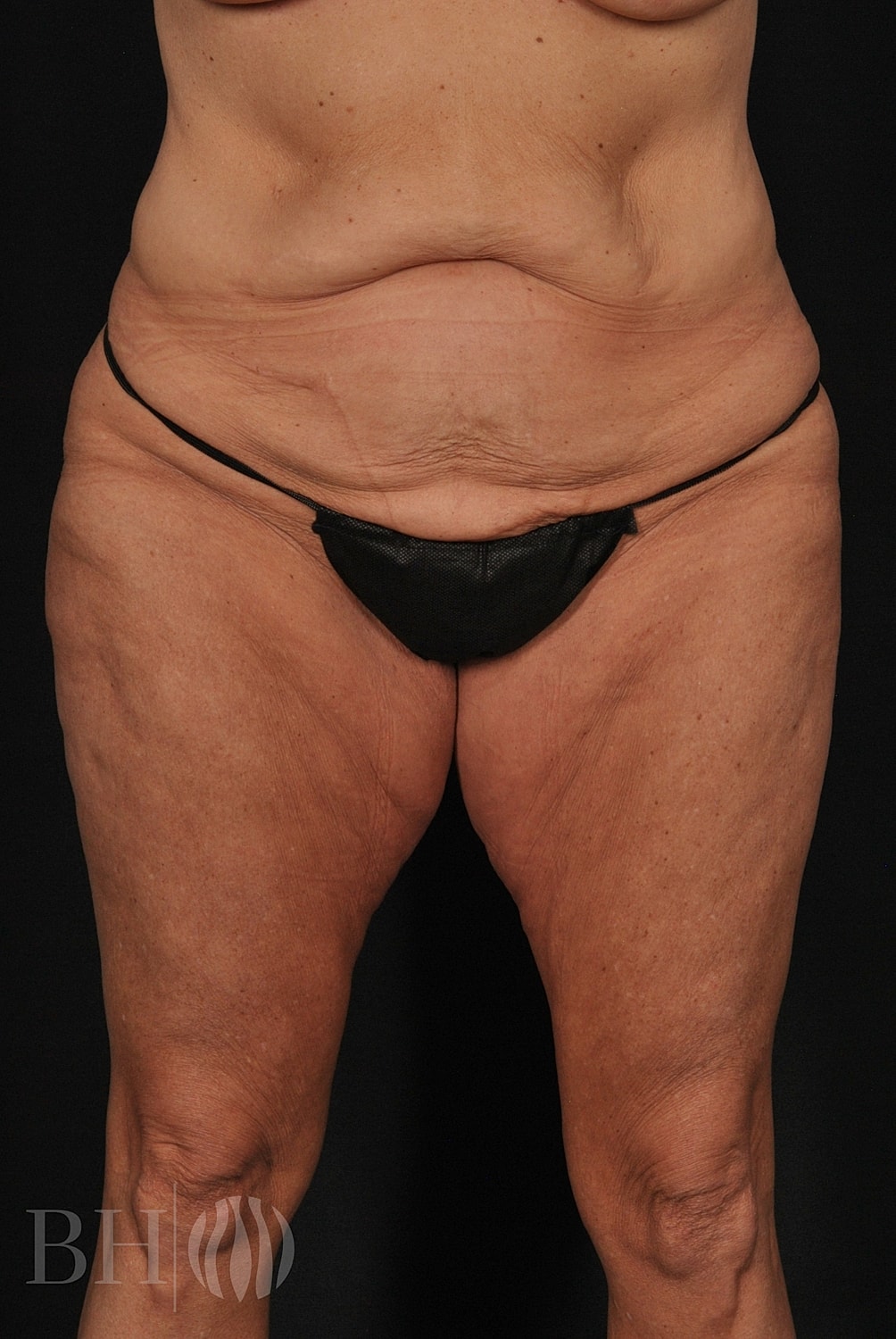 Tummy Tuck Before & After