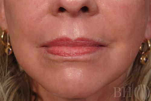 Laser Skin Resurfacing Before & After