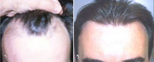 hair restoration neograft patient in baltimore