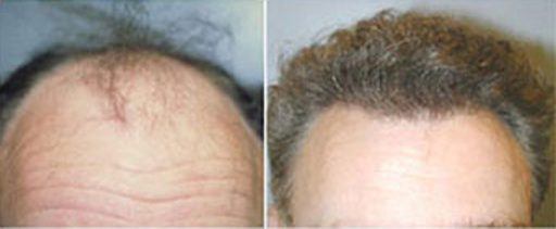 Hair Restoration in Baltimore | Hair Loss Treatment Maryland