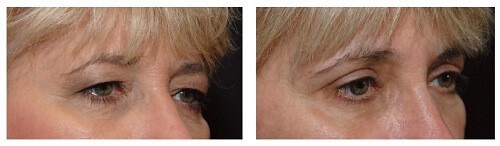 before after eyelid surgey eldery woman