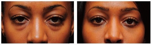 before after eyelid surgey black woman