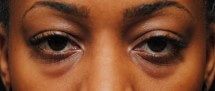 black woman before eyelid surgery