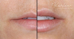 restylane silk lip injections