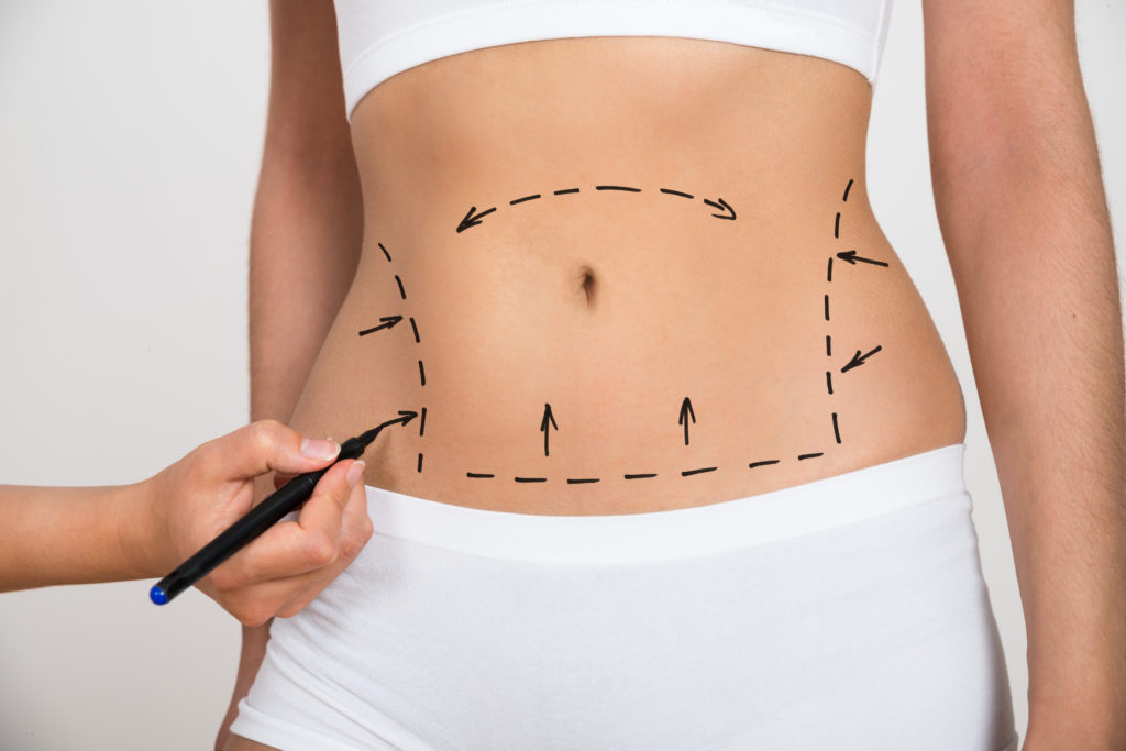 What are The Differences Between a Liposuction and Tummy Tuck