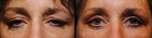 eyelift before after
