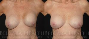 Breast revision before and after