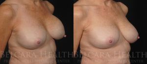Breast revision before and after