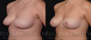 Breast implant before & after