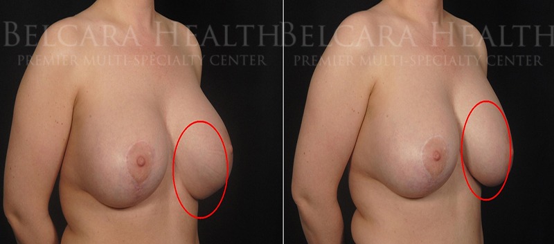 Breast Revision before and after