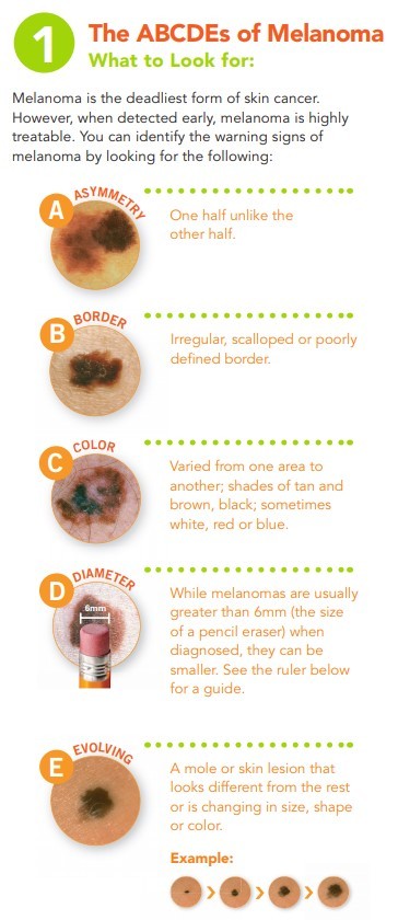 The ABCDEs of Melanoma