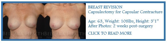 Breast Revision case of the month