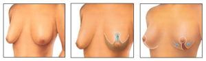 Breast augmentation diagram