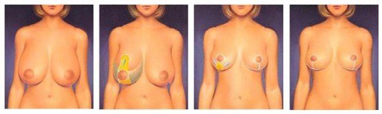 Breast reduction diagram