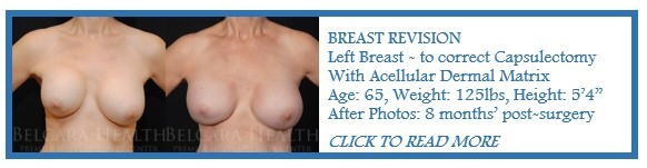 Breast Revision for Capsular Contracture case of the month