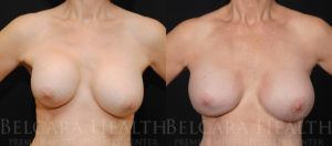 Breast revision before & after