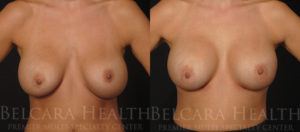 Breast revision before & after
