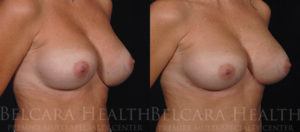 Breast implant before & after