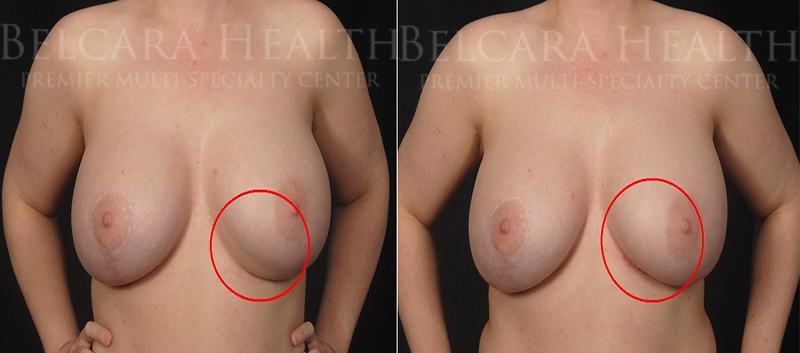 Breast Revision before and after