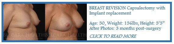 Capsular Contracture case of the month