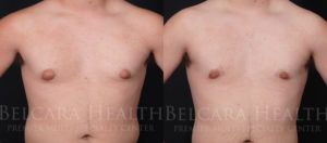 Male Breast Reduction before & after