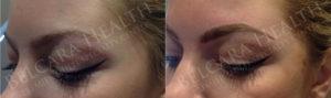 Cosmetic Eyebrow Tattooing Before & After