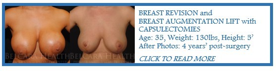 Breast Revision with Breast Augmentation & Lift case of the month